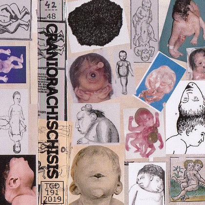 Craniorachischisis - Craniorachischisis Craniorachischisis - Craniorachischisis